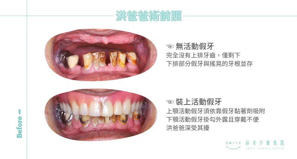 活動假牙全口缺牙