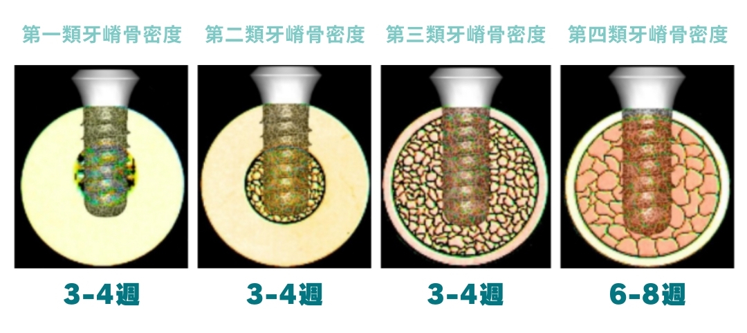 植牙治療再進化_紀