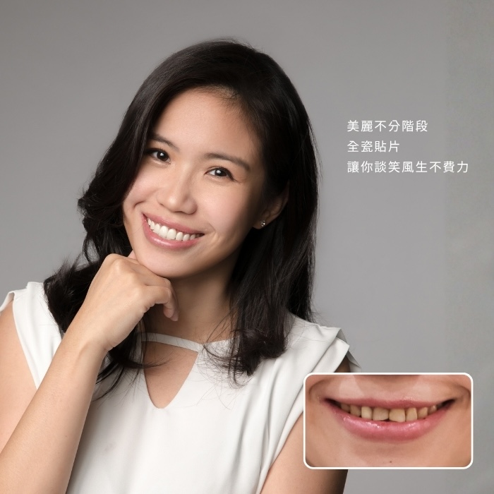美麗不分階段，全瓷貼片讓你談笑風生不費力