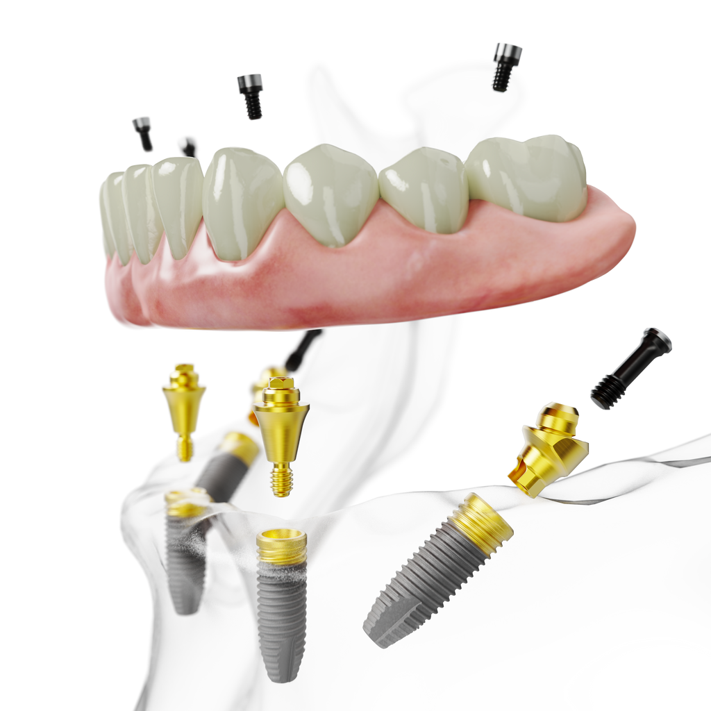 All-on-4 TiUltra_hero 1_lower jaw NobelParallel (1)