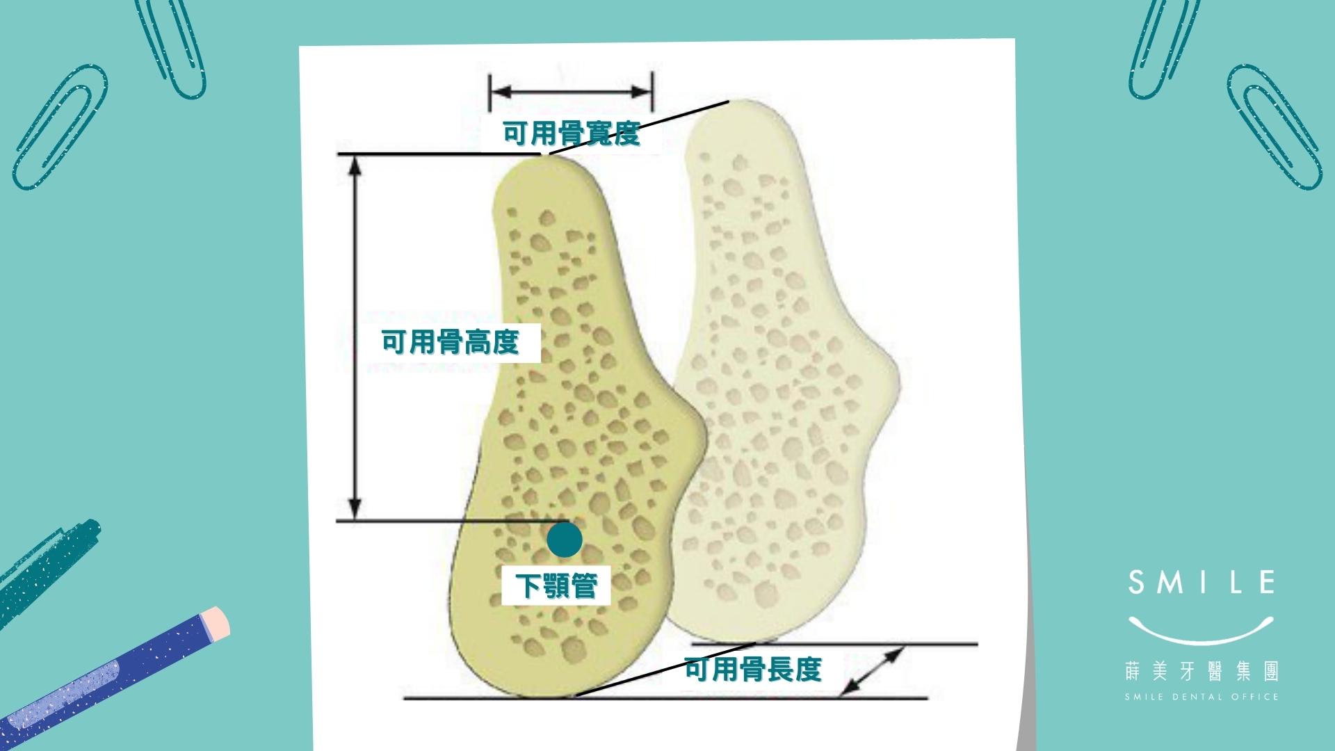 可用的骨頭高度：從齒槽脊頂到相對應的解剖構造為可用的骨頭高度。可用距離受限於重要解剖構造，例如：上顎鼻竇、下顎齒槽神經。 可用骨頭的寬度：頰（唇）側骨板( facial plate