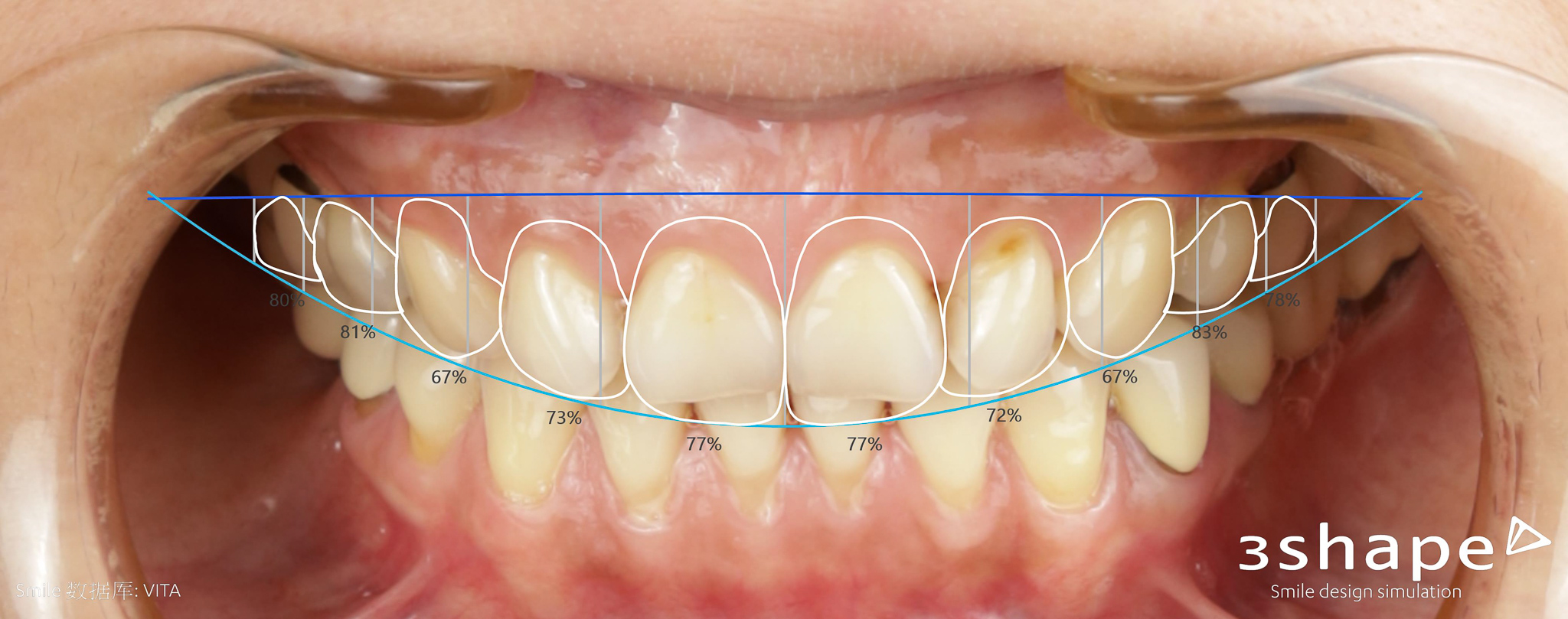 20211130 2D Upper jaw Close Up