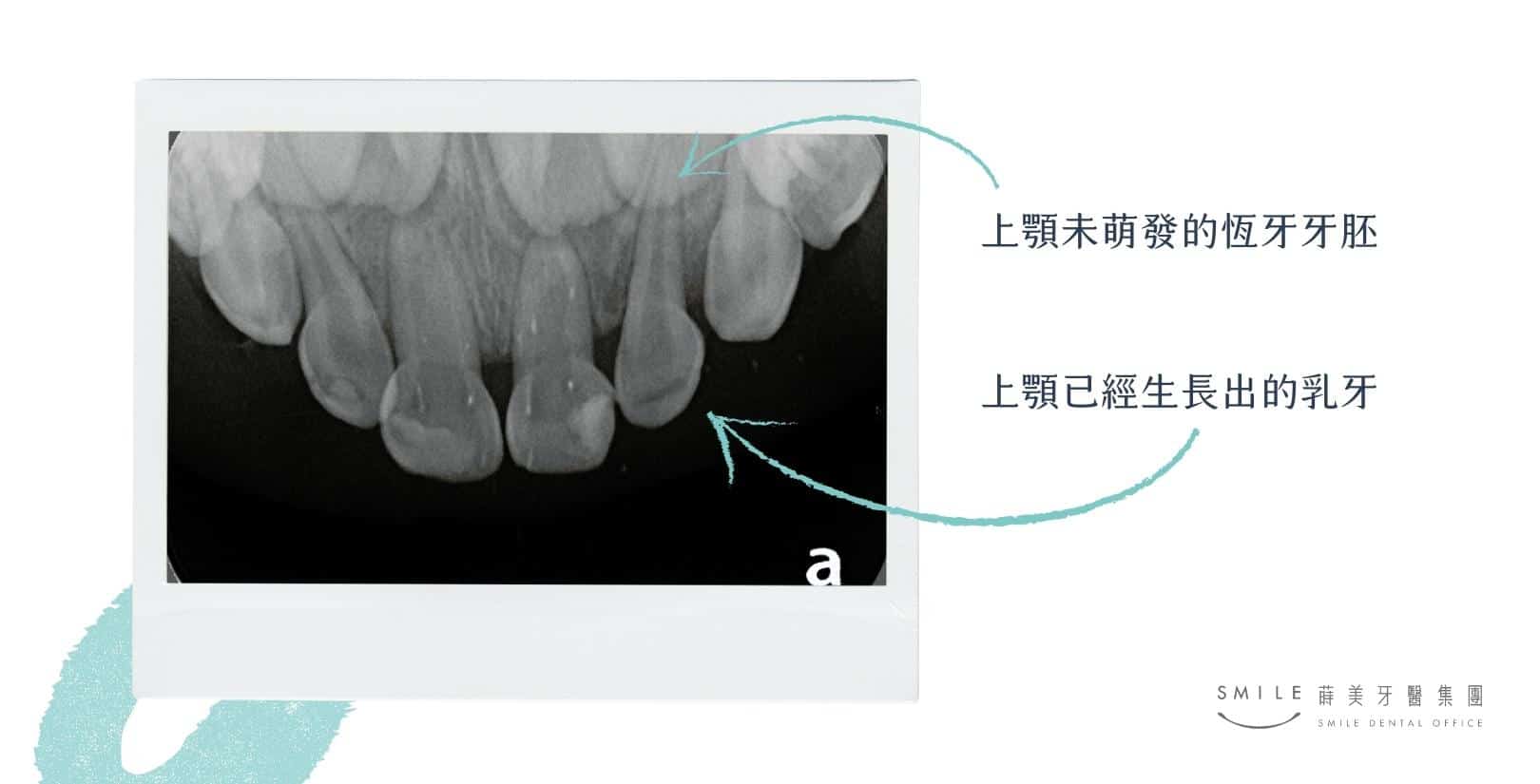 乳牙X光