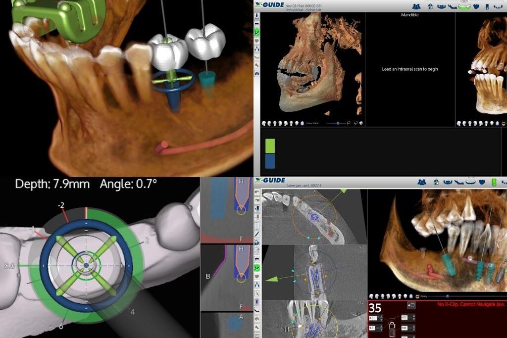 X-Guide 3D植牙導航系統 (1)