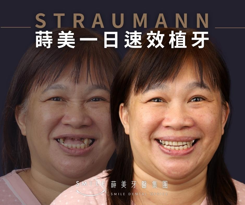 品味美好人生，選擇最好的植體Straumann