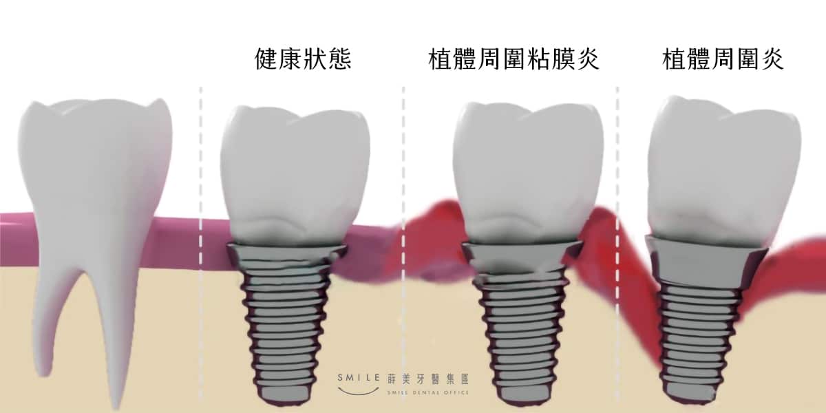 植體周圍疾病的破壞程度分類