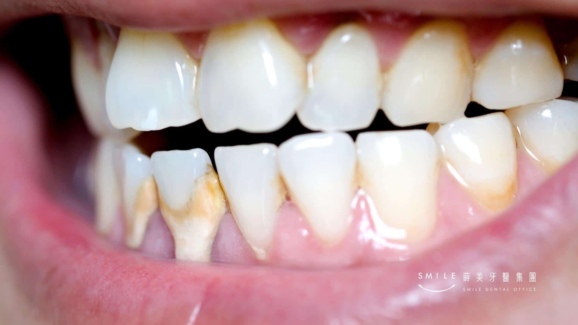 植體周圍炎成因可能為牙周病史導致