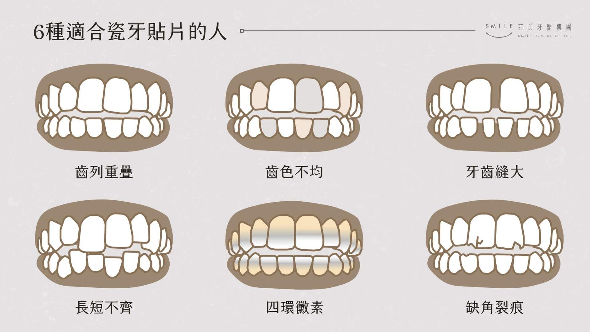 裝上陶瓷貼片的前後對比