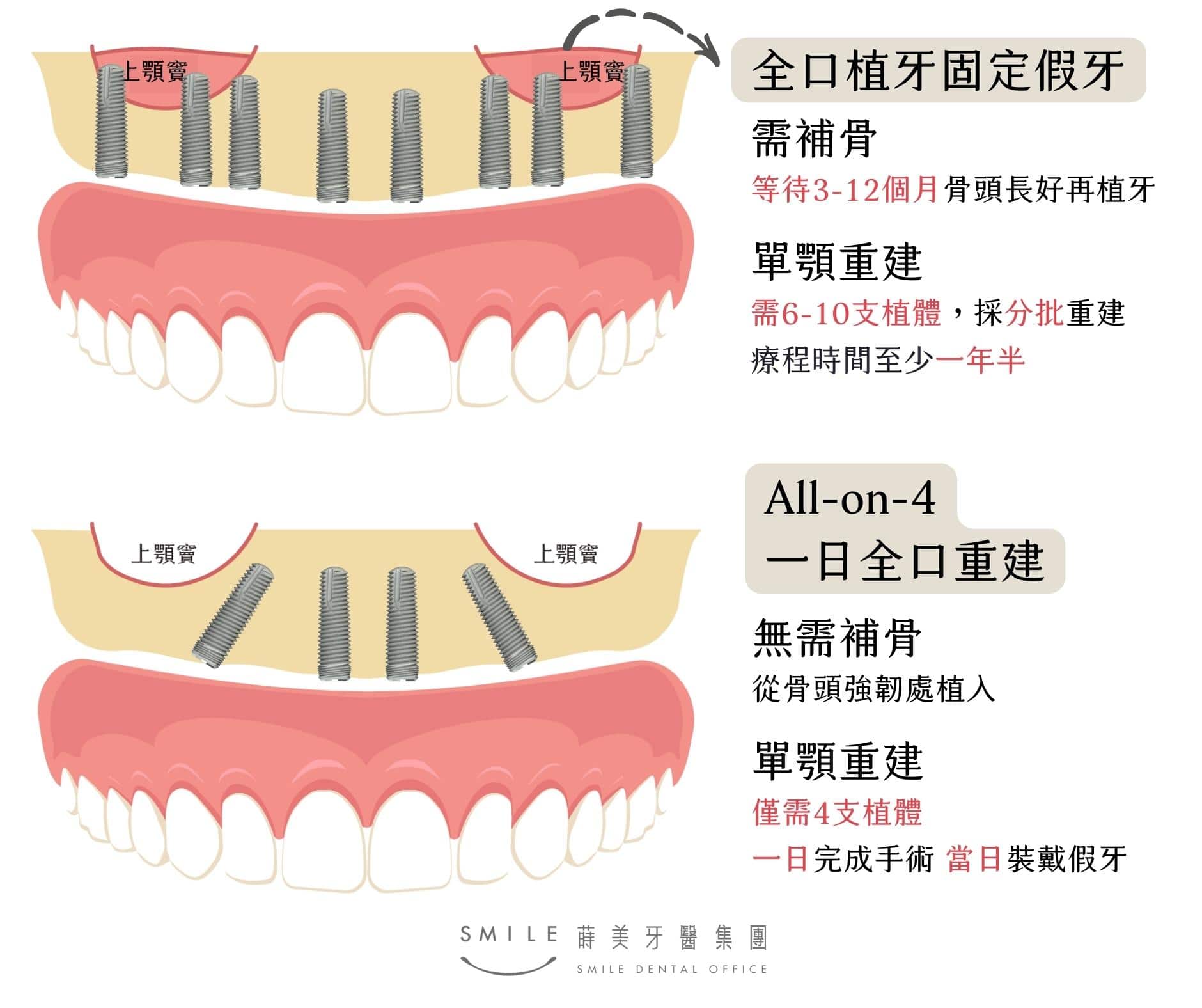 All-on-4價格較便宜原因