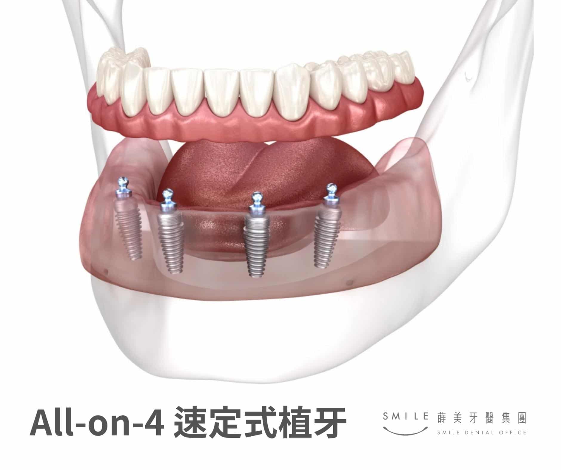 All-on-4速定式植牙