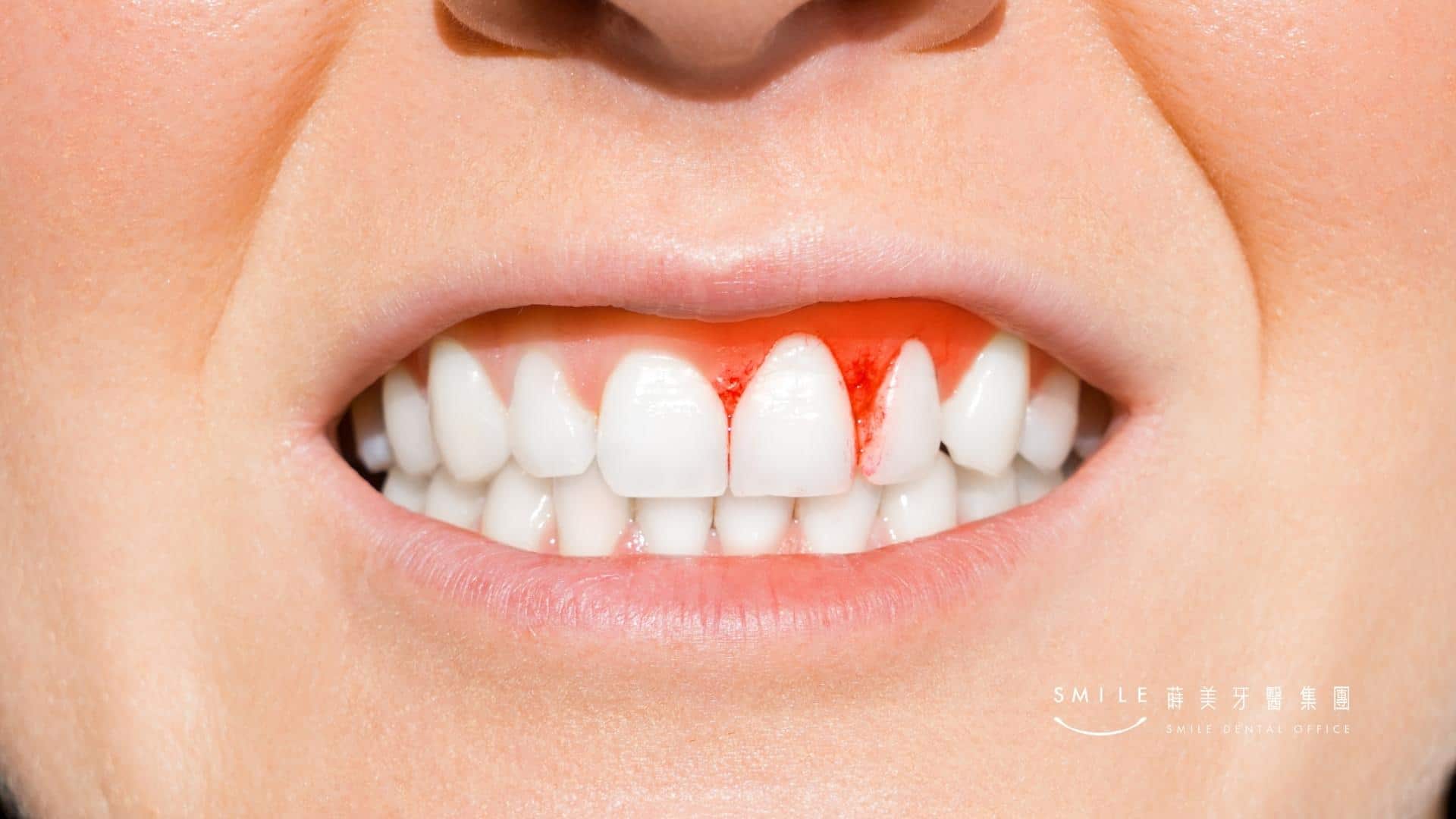 植體周圍炎成因可能為牙周病史導致