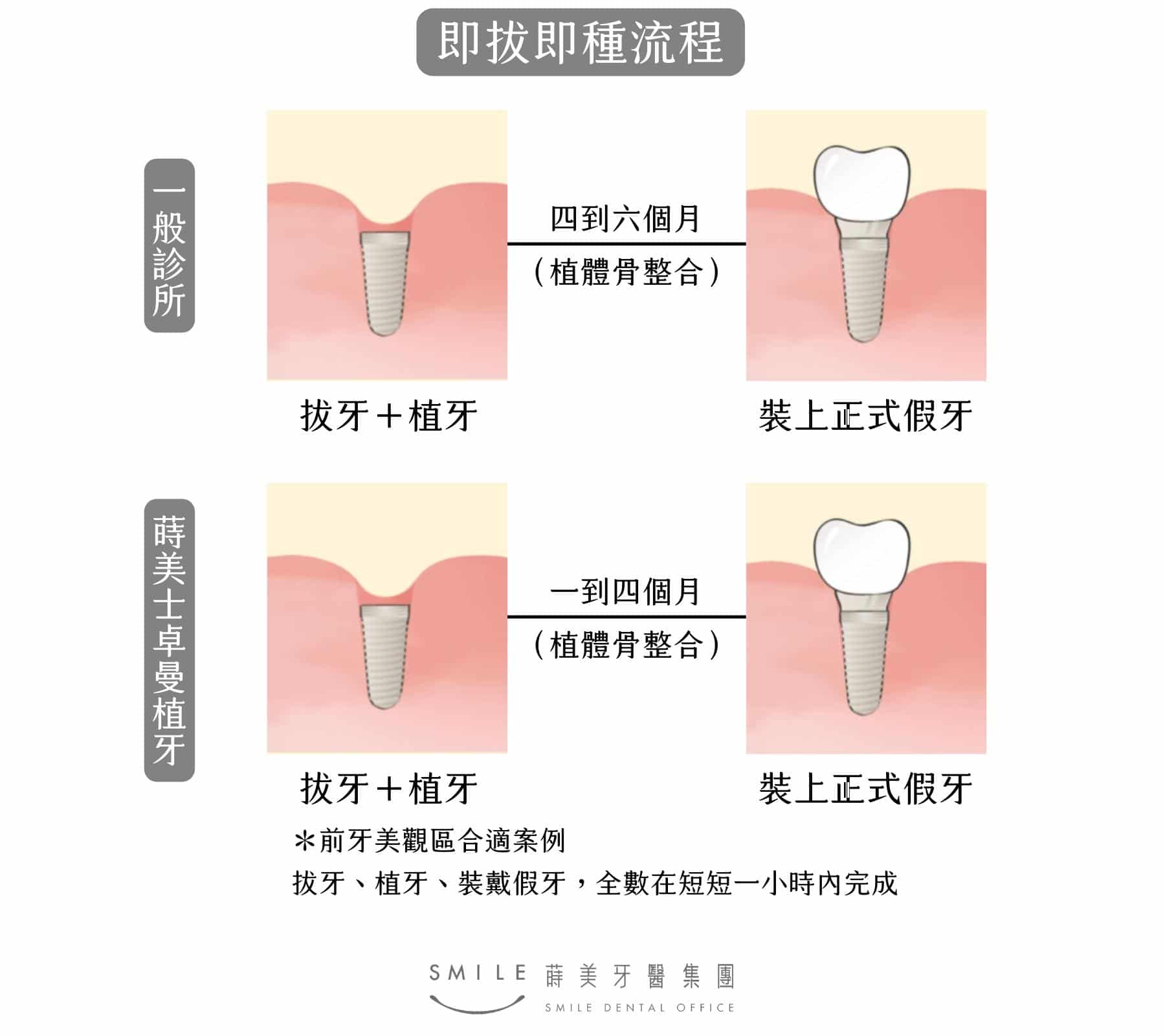 快速植牙過程｜台北新北蒔美牙醫集團｜All-on-4全口重建/植牙專科醫師團隊