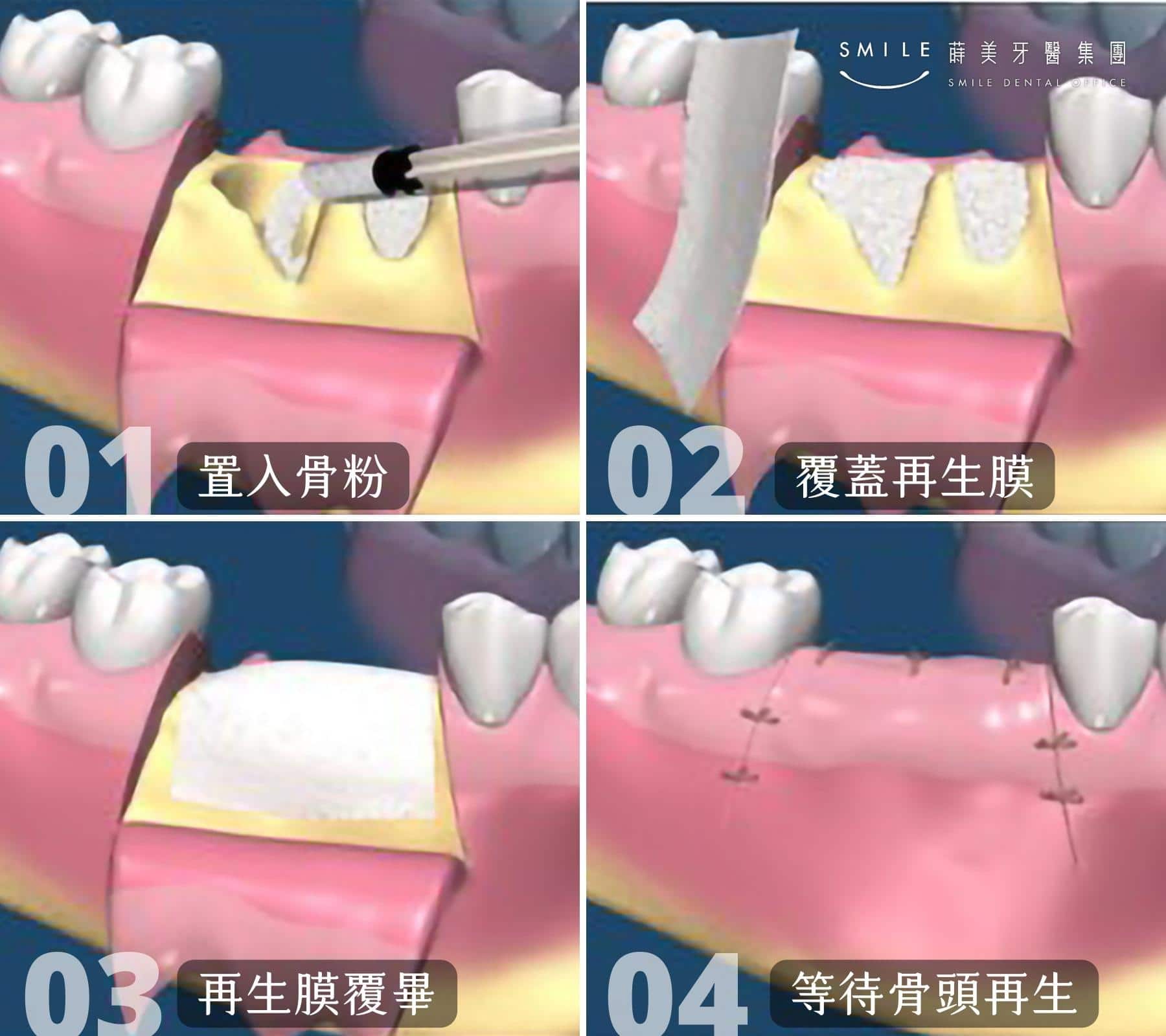 引導骨再生術示意圖