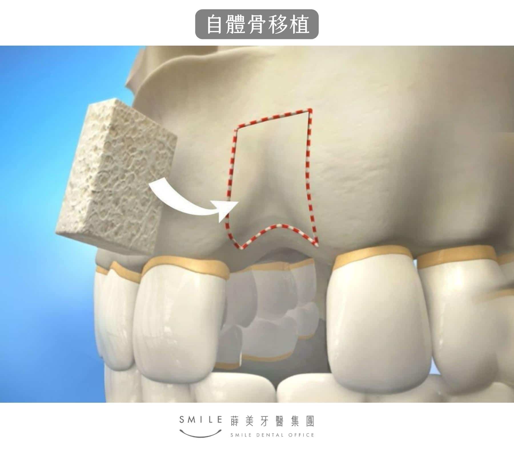 引導骨再生術示意圖