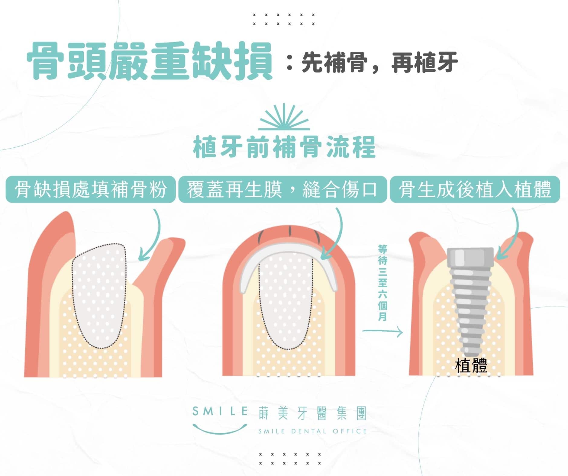 植牙補骨粉過程