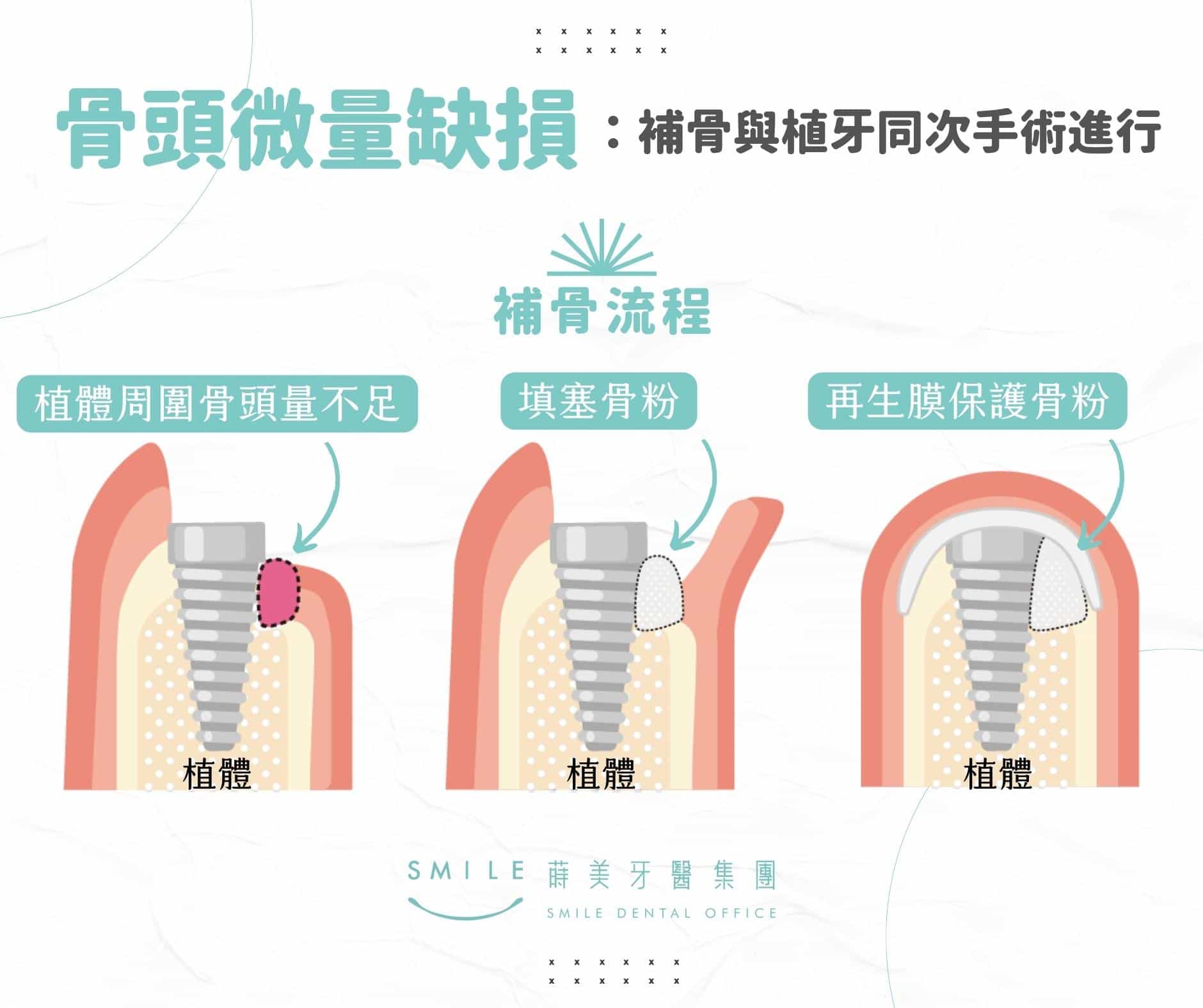 植牙補骨粉過程