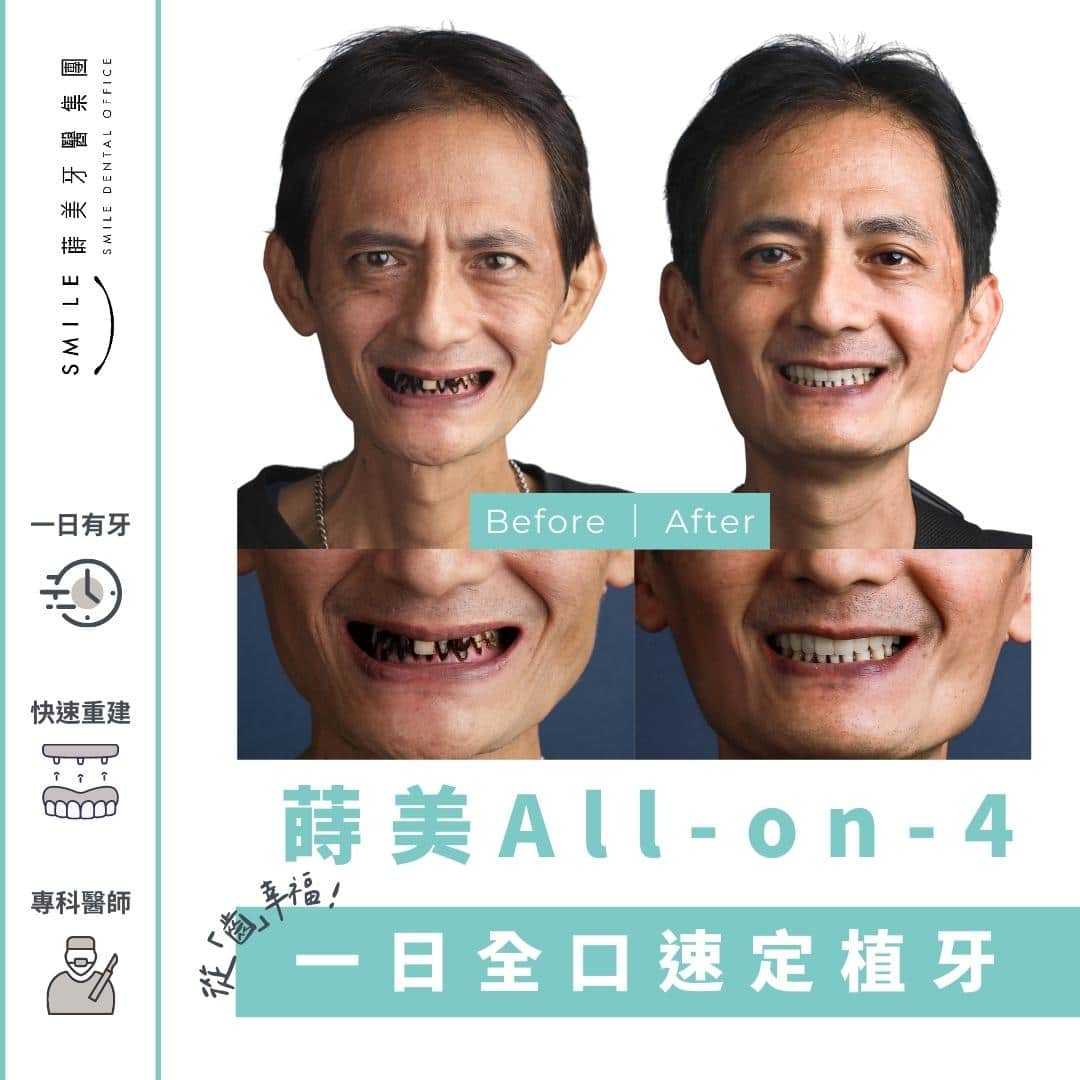 All-on-4 從「齒」幸福