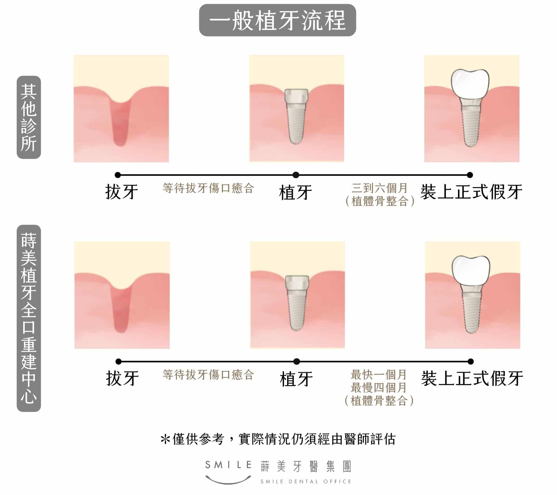 一般植牙流程
