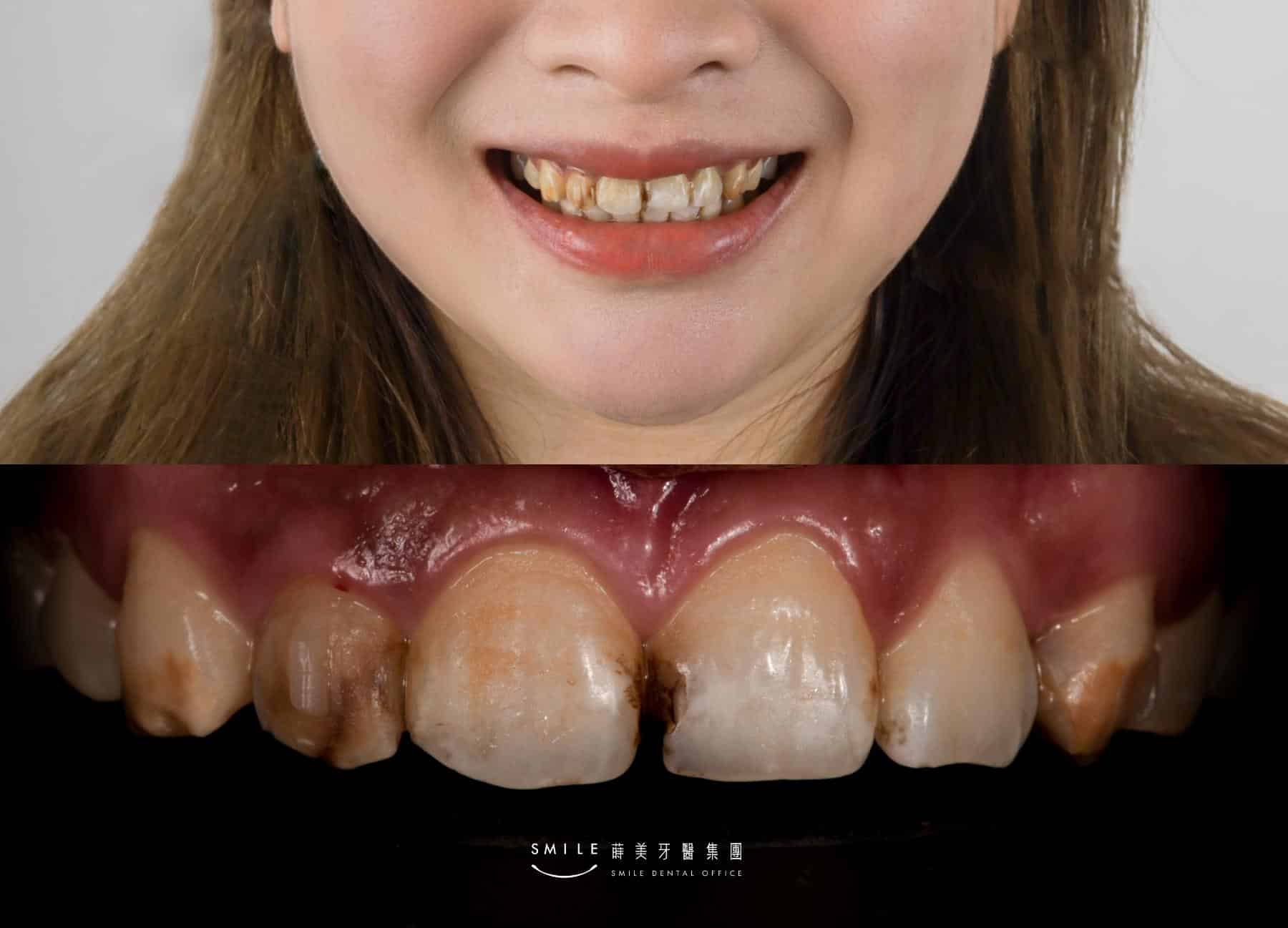 牙縫大原因：長期缺牙