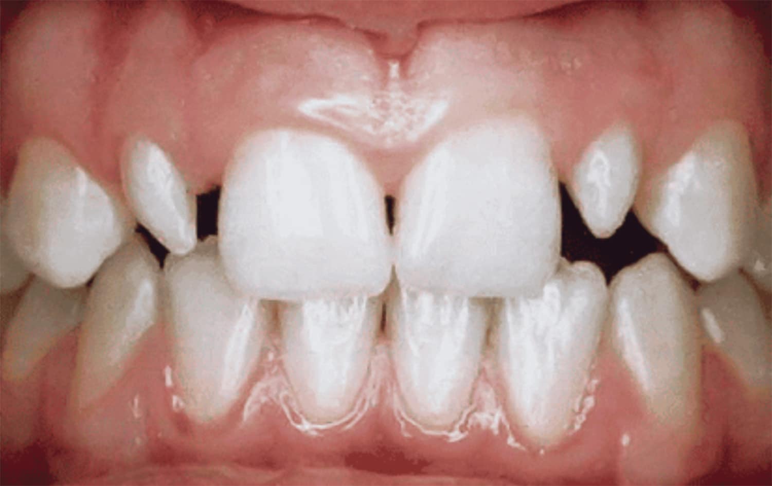 牙縫大原因：釘狀齒