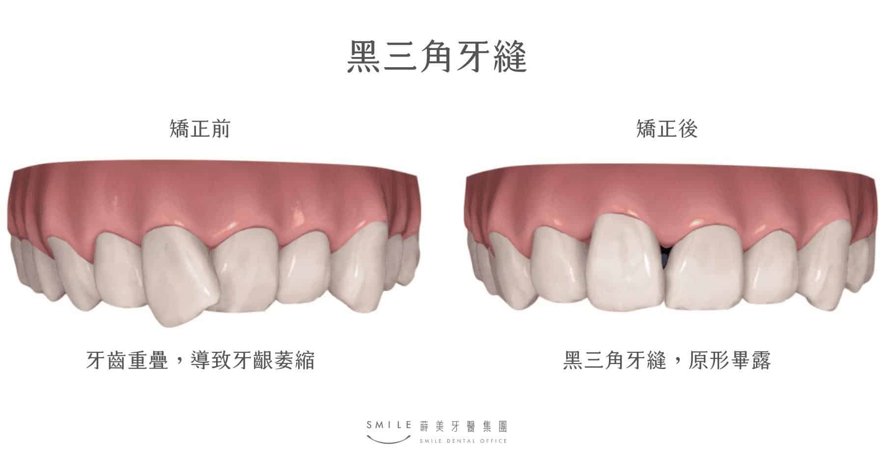 牙縫大原因：矯正後的黑三角