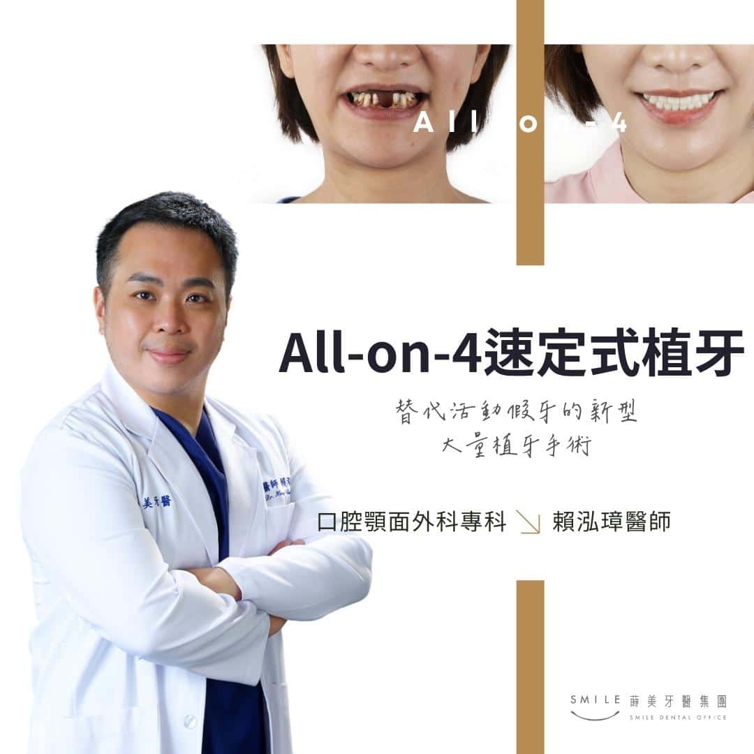 All-on-4速定式植牙｜替代活動假牙的新型大量植牙手術
