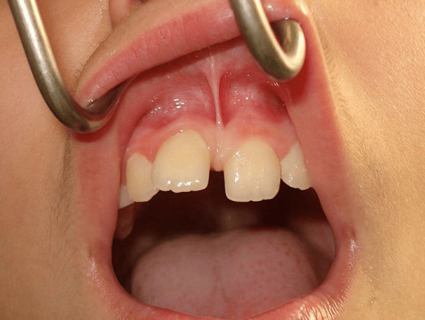 牙縫大原因：唇繫帶