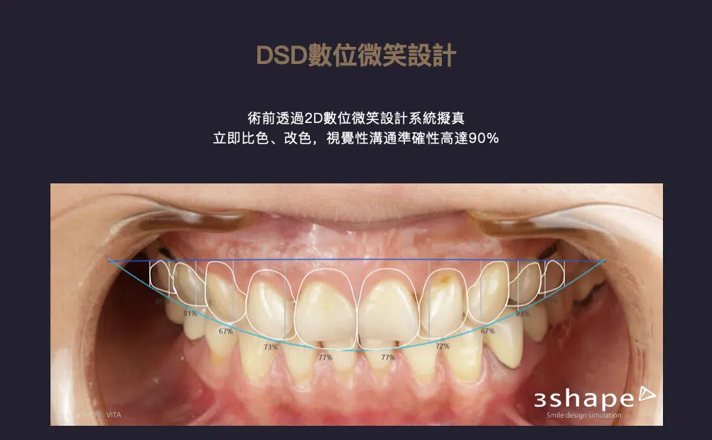 上下排牙縫大可以來蒔美全瓷笑容重建隱形矯正中心諮詢