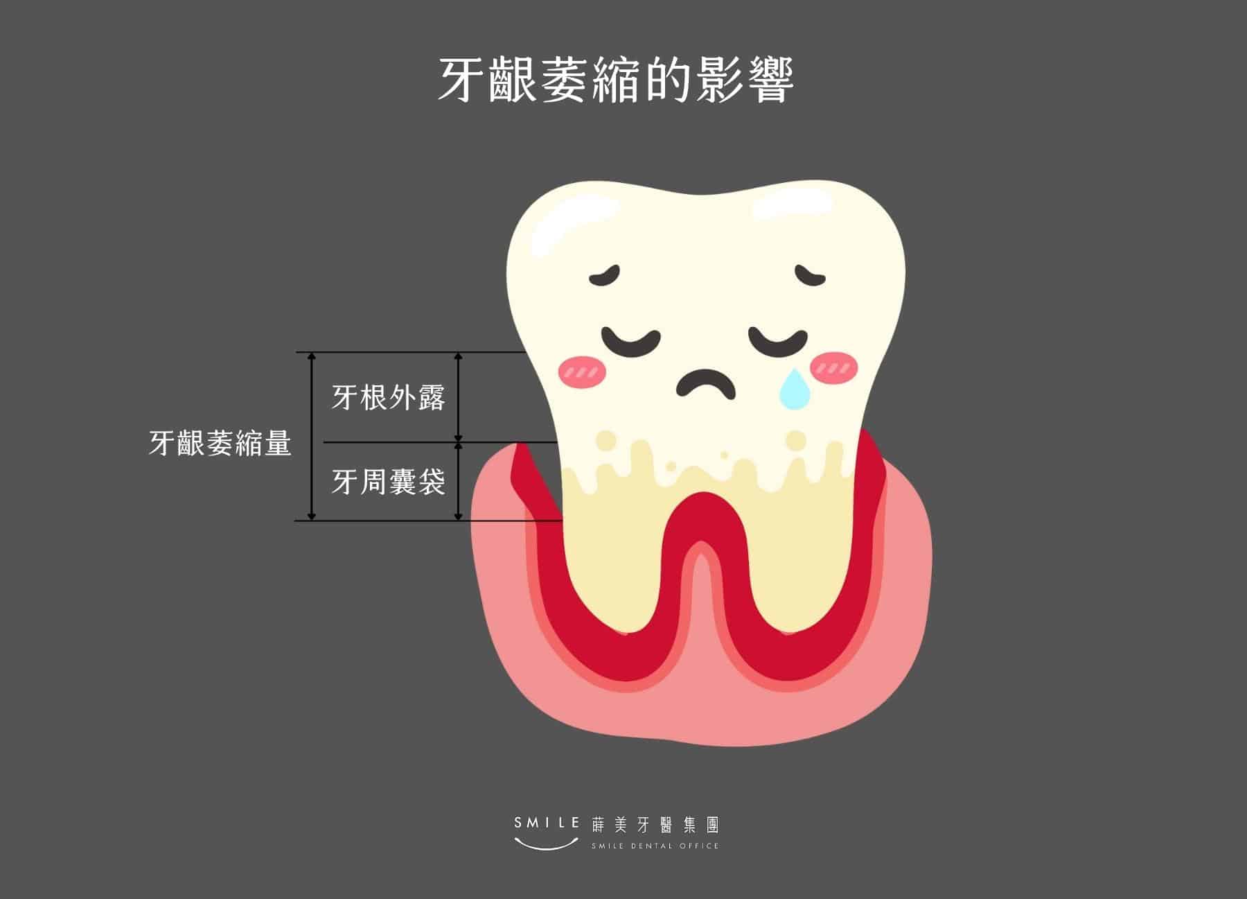 牙齦萎縮導致牙縫大的示意圖