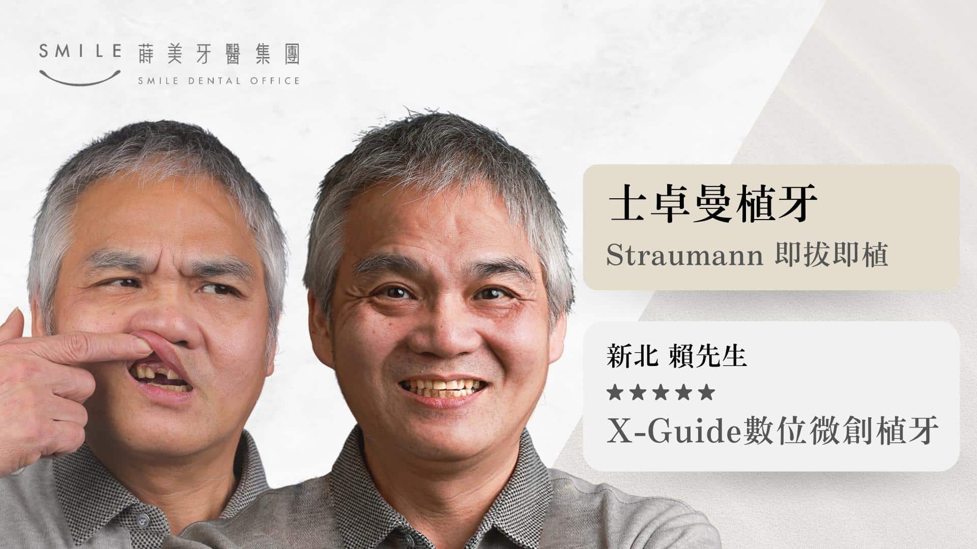 蒔美straumann植牙案例