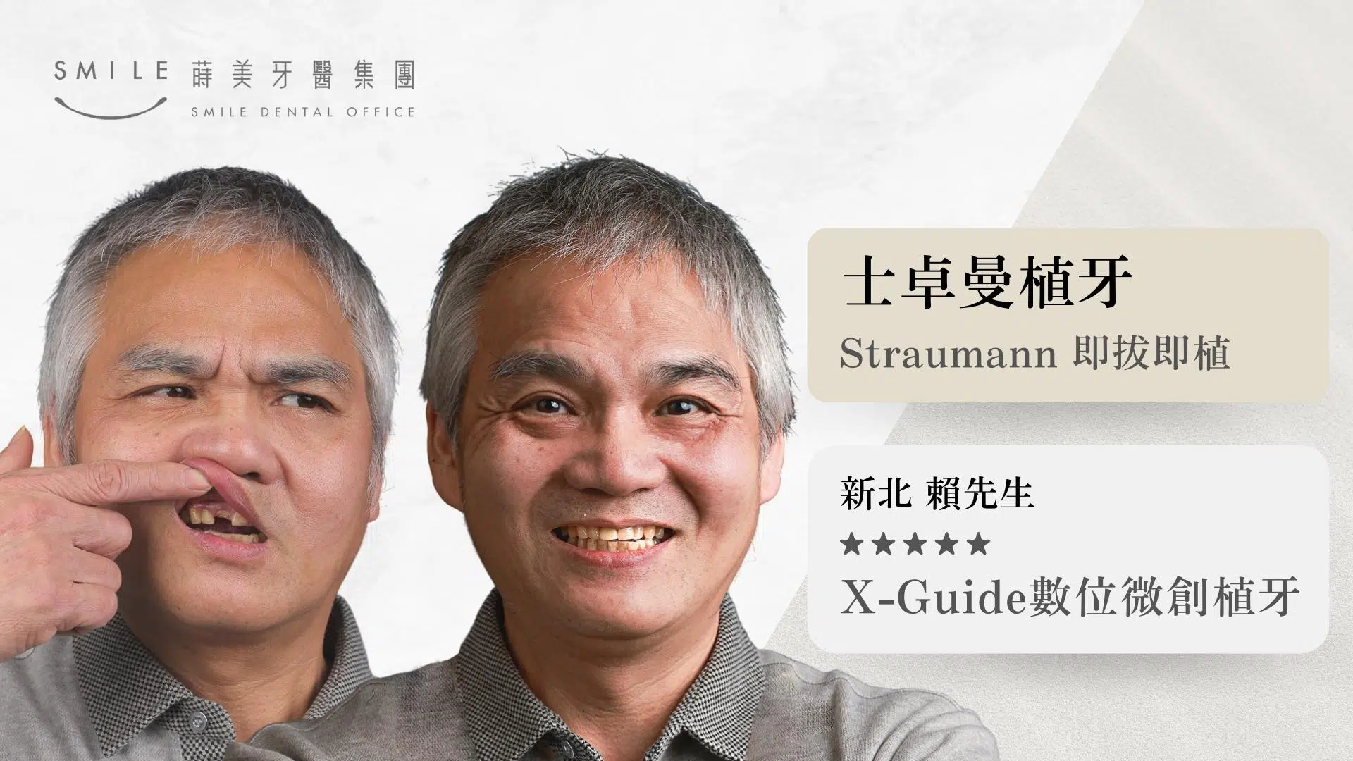 蒔美straumann植牙案例｜台北新北蒔美牙醫集團｜All-on-4全口重建/植牙專科醫師團隊