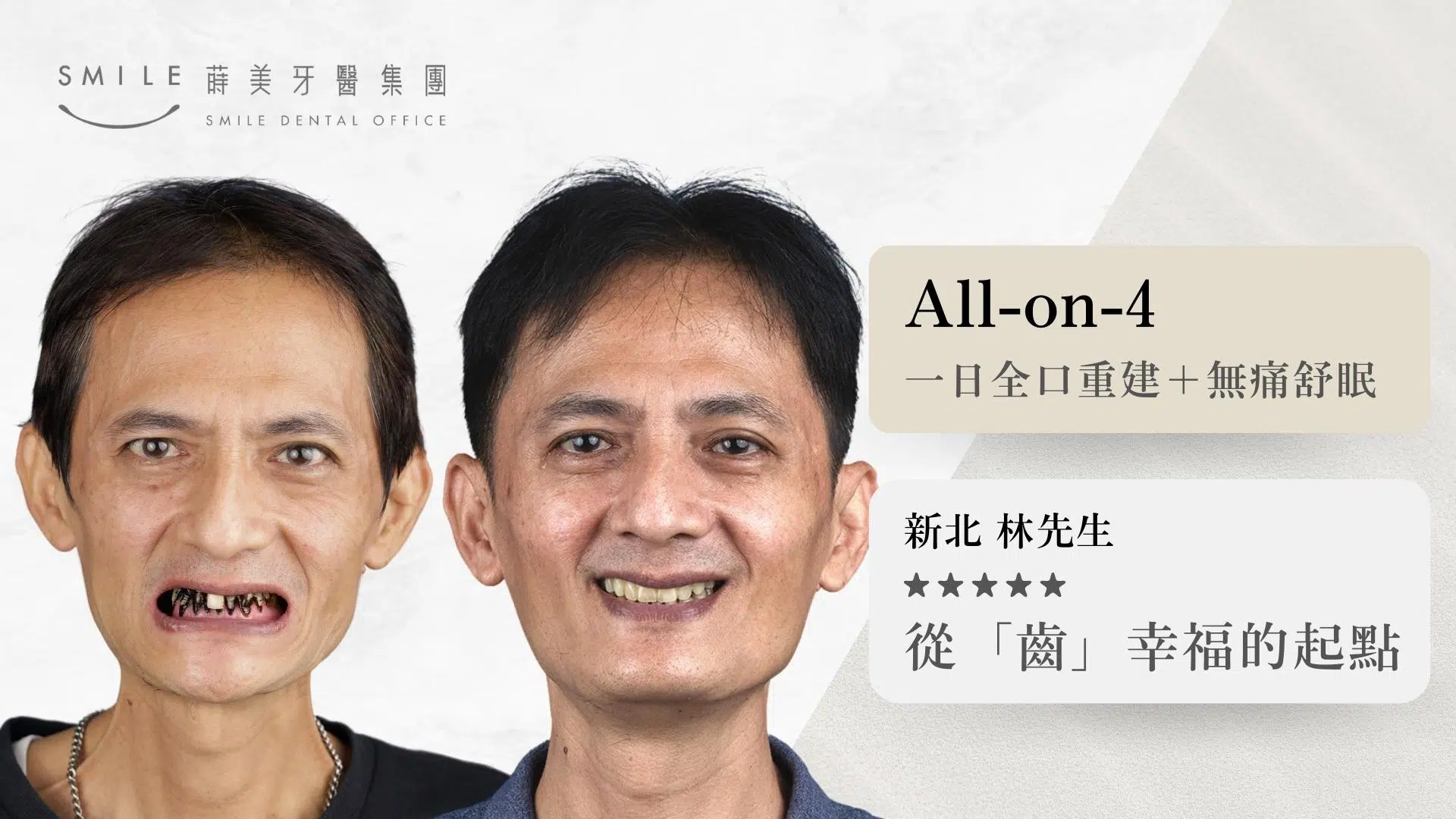 蒔美全口重建案例