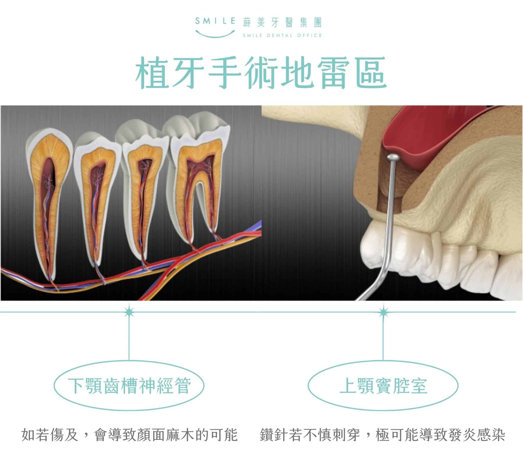 植牙風險情況－上顎竇腔室或下齒槽神經受損