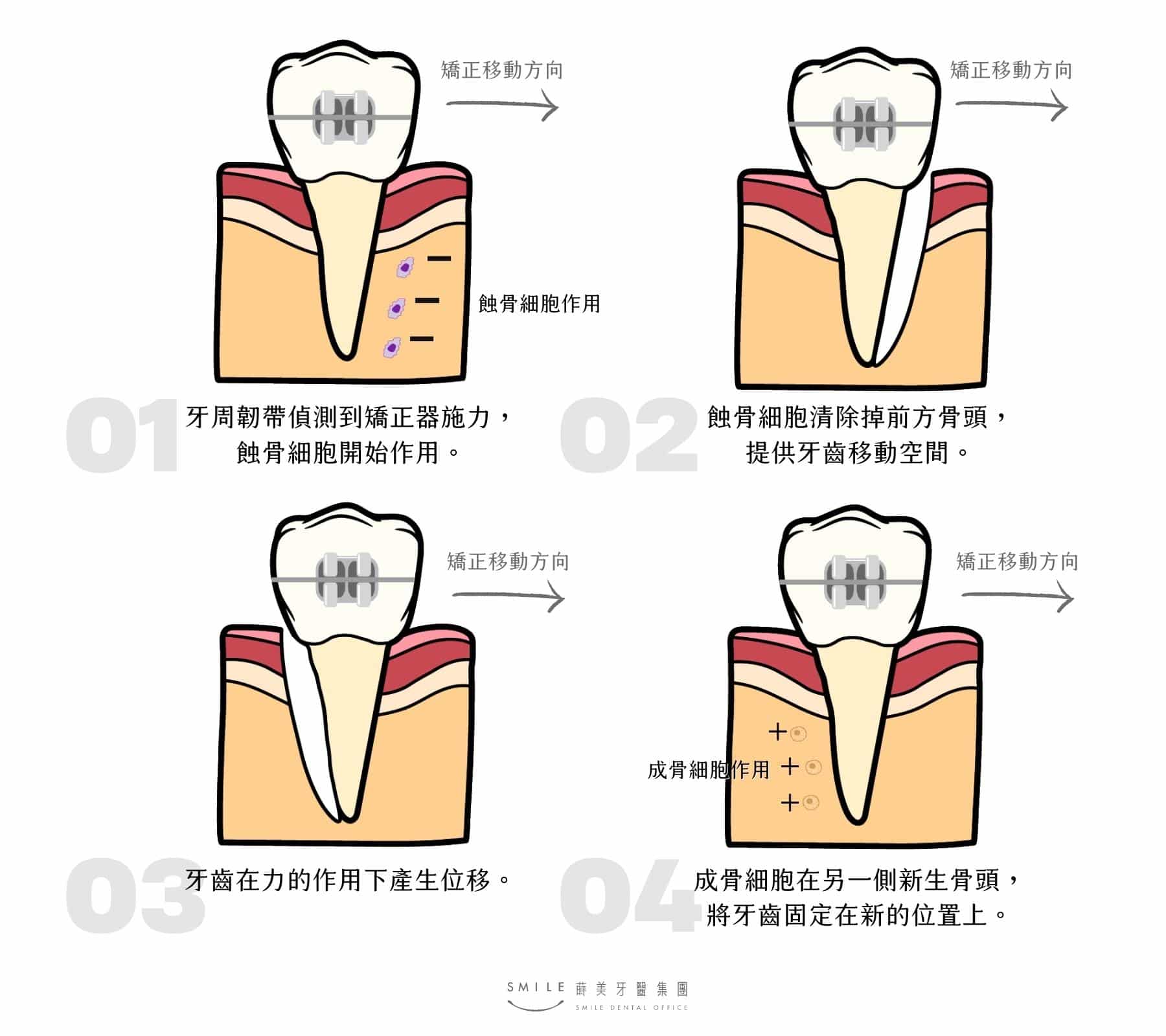 牙齒矯正原理說明