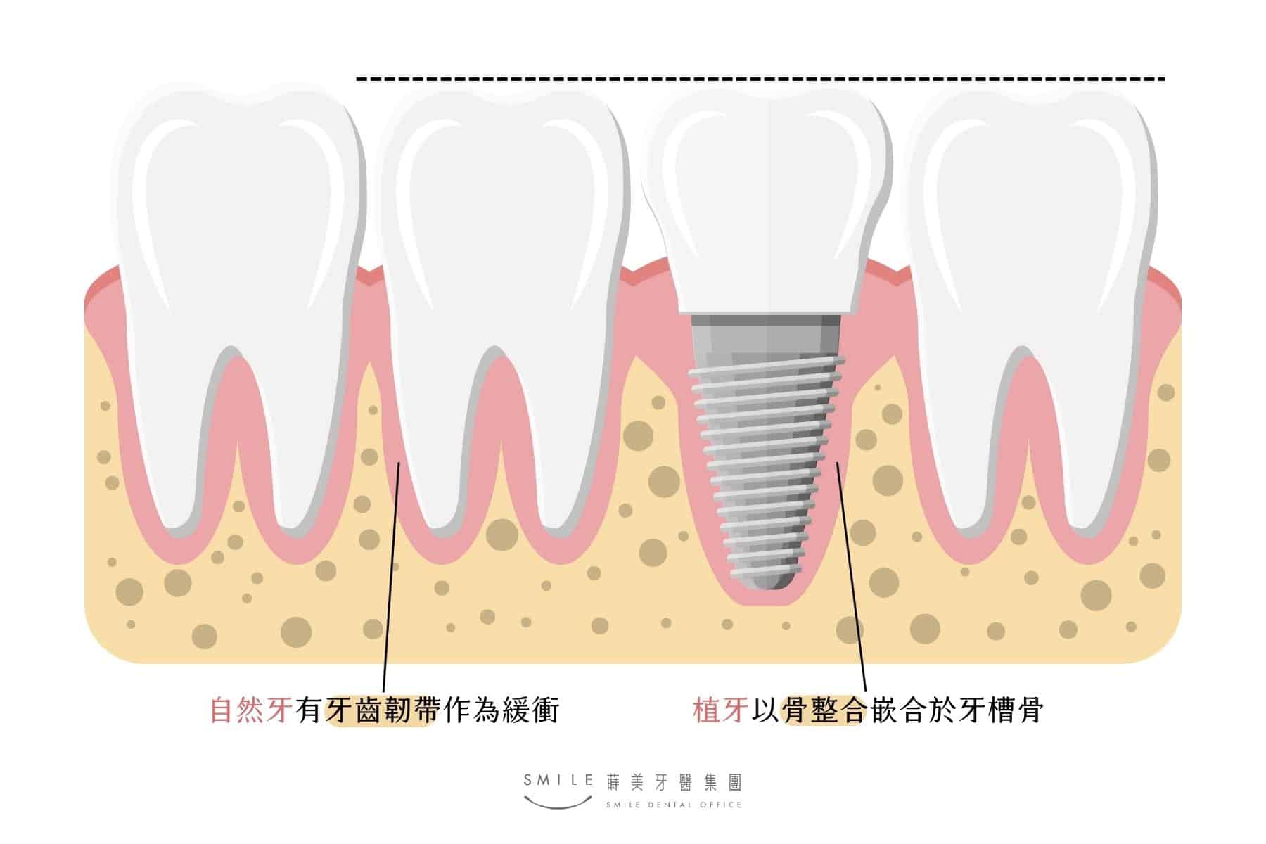 自然牙有牙齒韌帶作為緩衝