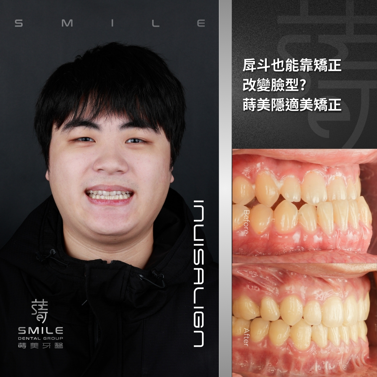 invisalign隱適美案例-台北隱形矯正推薦-蒔美牙醫-葉先生