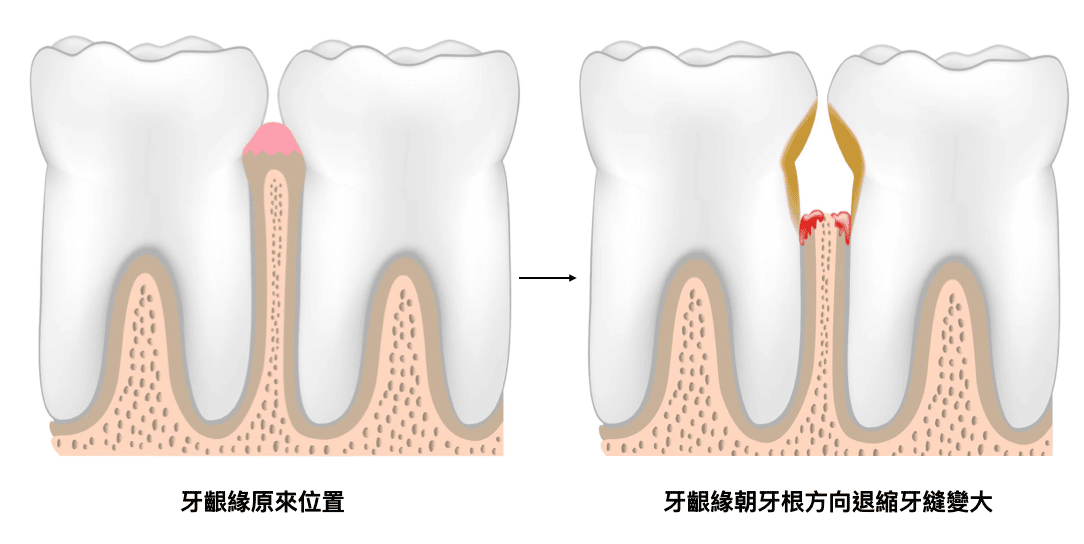 牙縫大如何補救