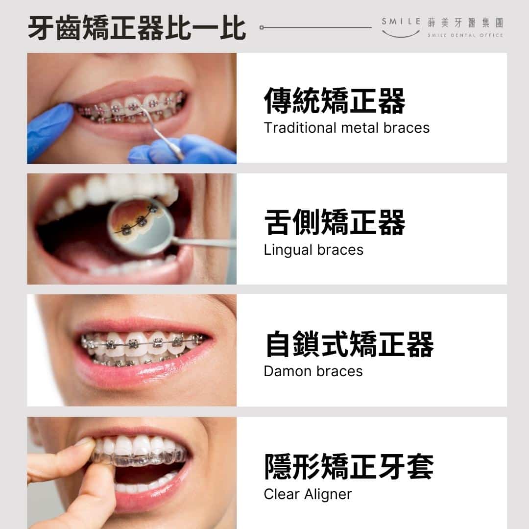 常見的牙套類型大致上可分成5種