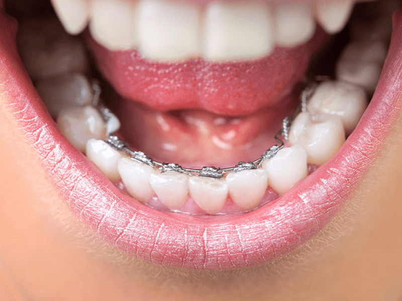 舌側矯正器容易出現清潔死角以及暫時性發音困擾，並非每個人都適合。