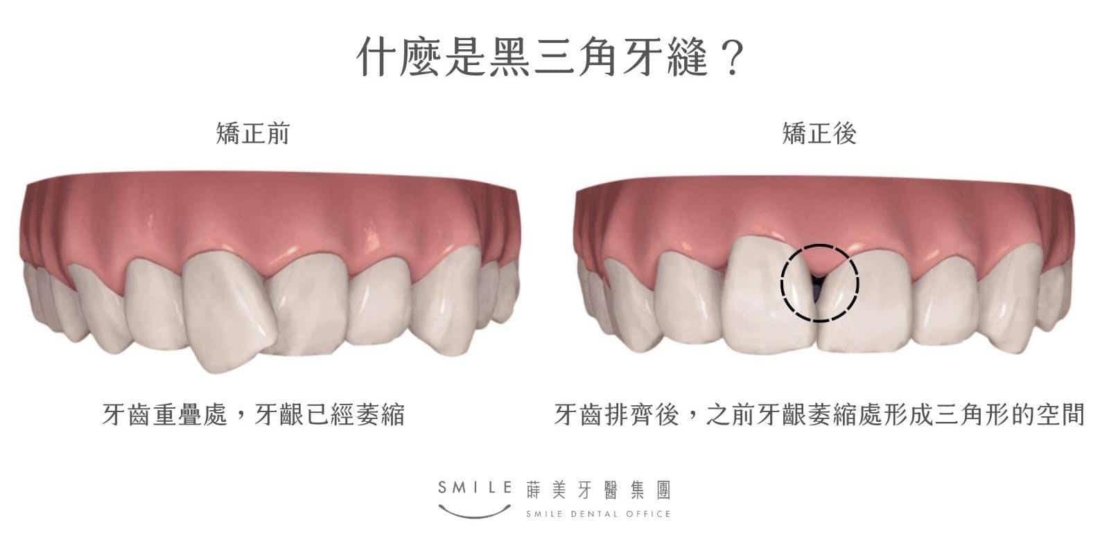 什麼是黑三角牙縫