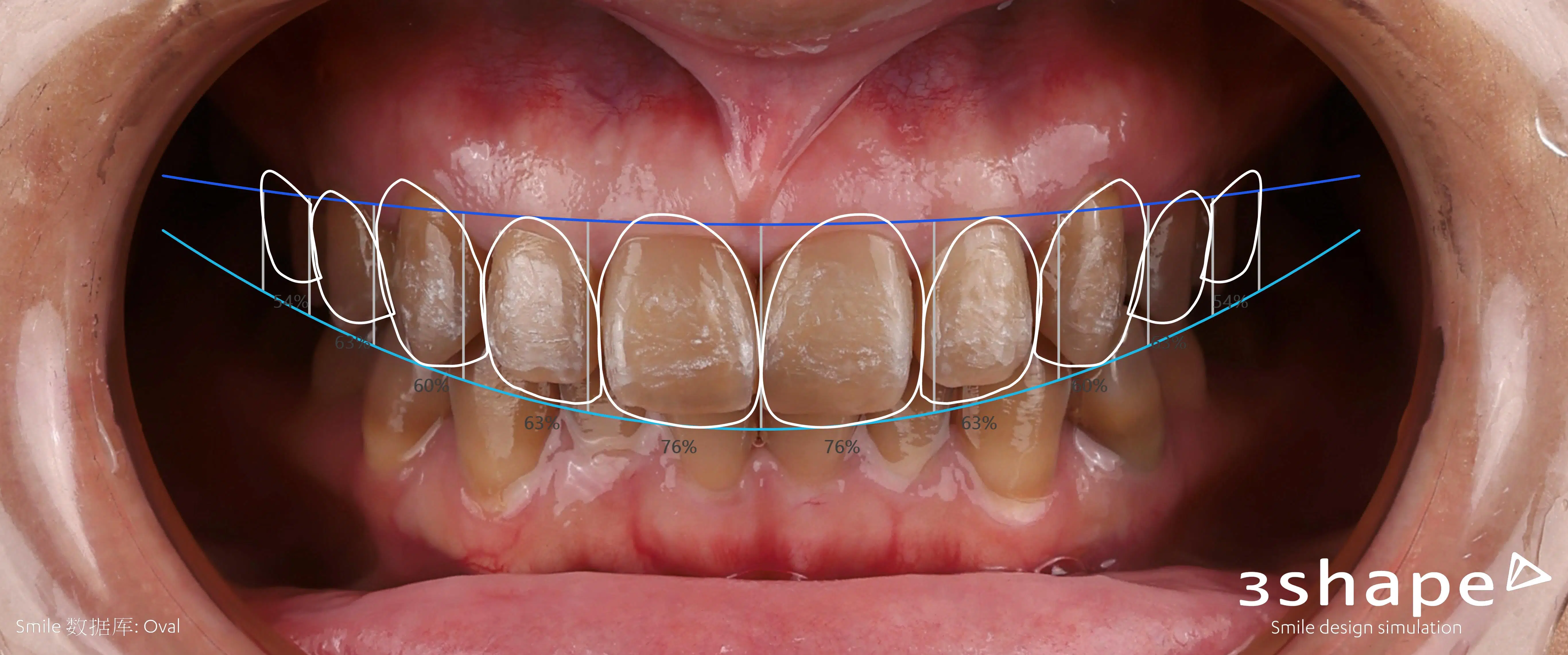 23 Upper jaw Close Up