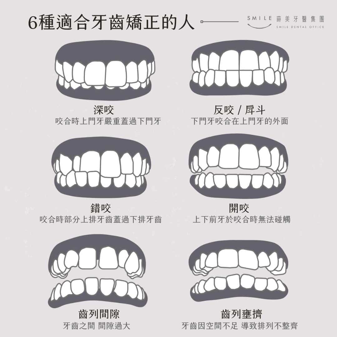 先檢查牙齒狀況再挑選合適的牙套類型