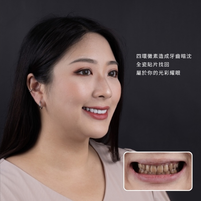 四環黴素造成牙齒暗沈，全瓷貼片找回屬於你的光彩耀眼｜板橋瓷牙貼片、隱適美矯正複合治療