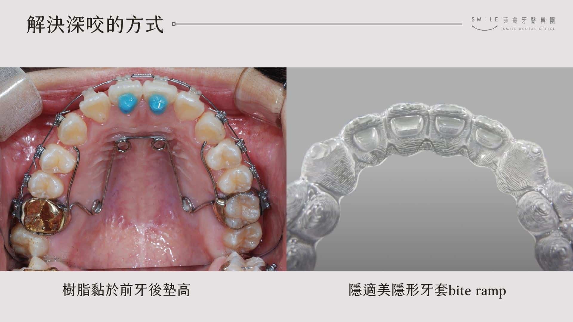 在前牙墊高以固定咬合、隱適美研發出的牙齒附件