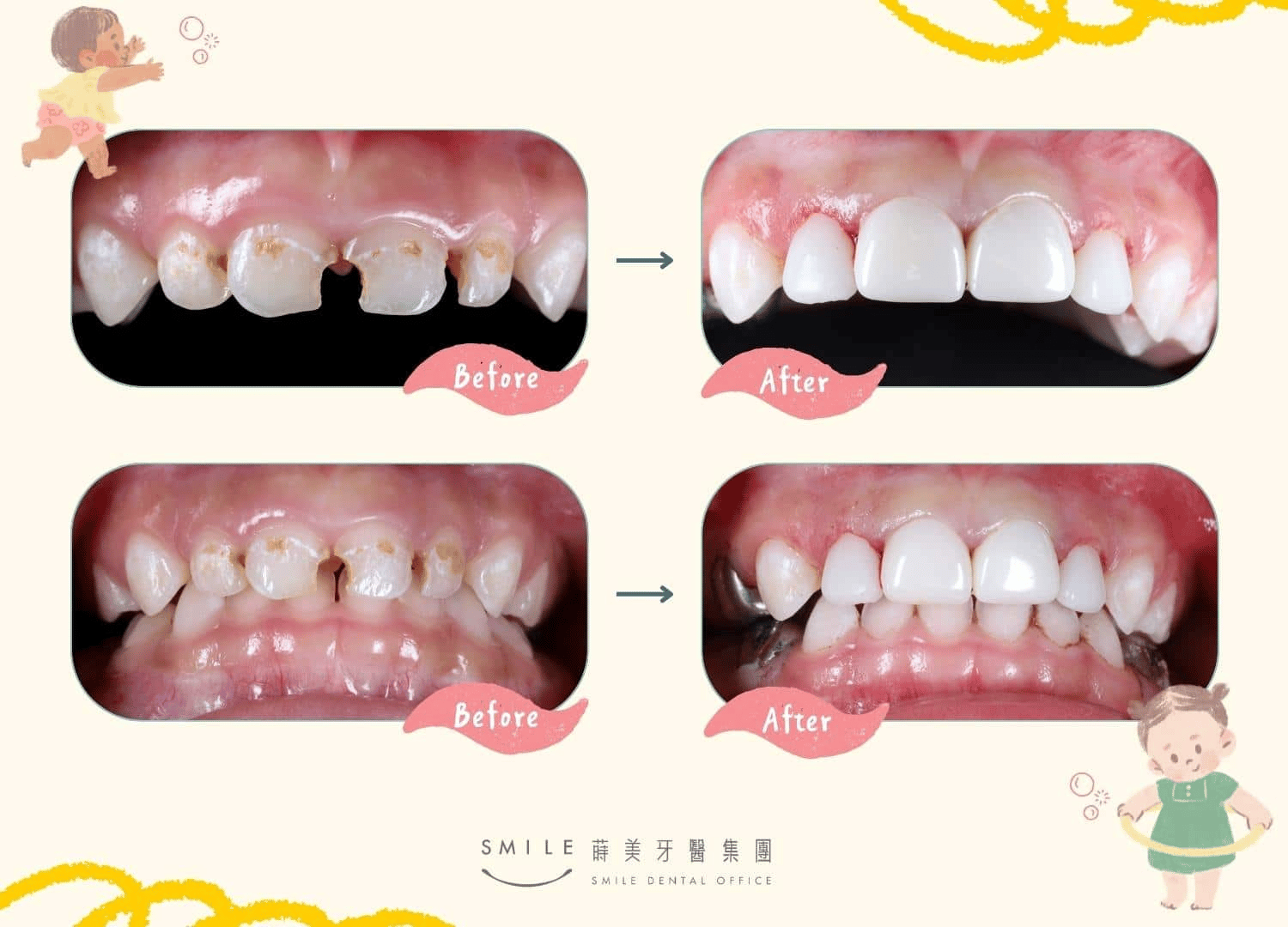 兒童舒眠牙醫治療可一次解決多項牙齒疾病問題