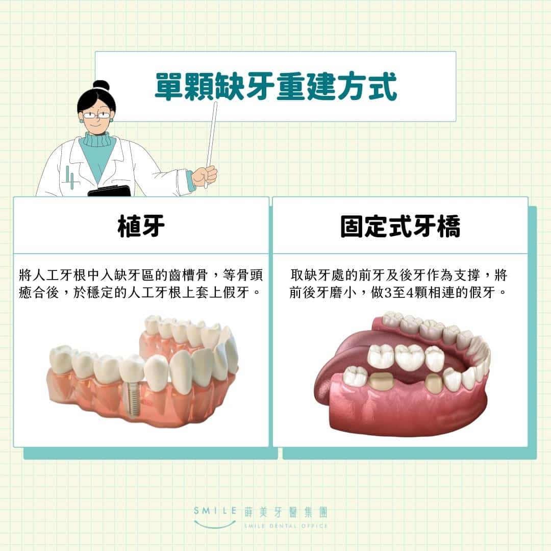 單顆缺牙重建方式-植牙假牙差異？植牙壽命、價格流程、後遺症、優缺點與風險詳解 -蒔美牙醫集團
