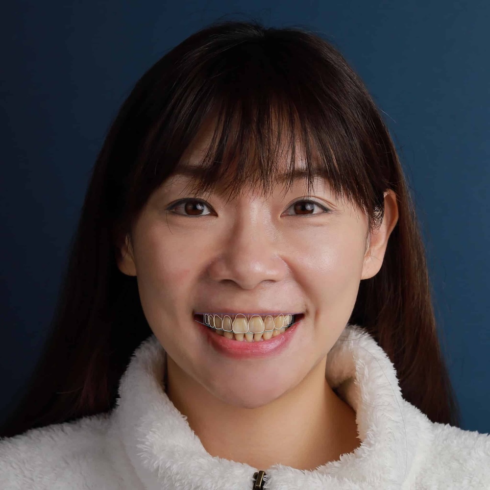 李-Upper-jaw-Smile-design-2