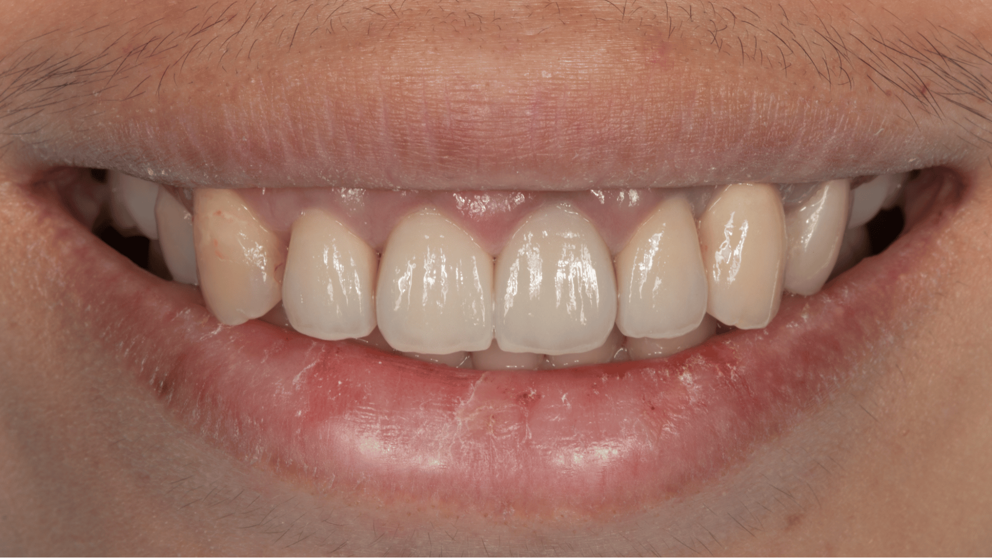 牙齦外露手術可讓露出的牙齒比例更美觀