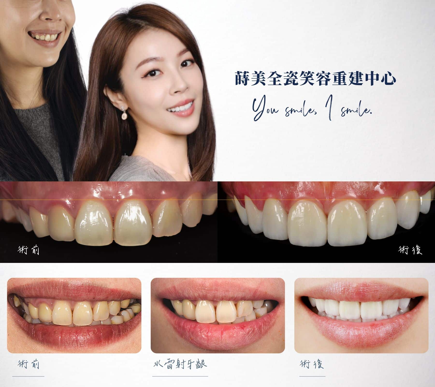 牙冠增長術加瓷牙貼片可以改善牙齦外露