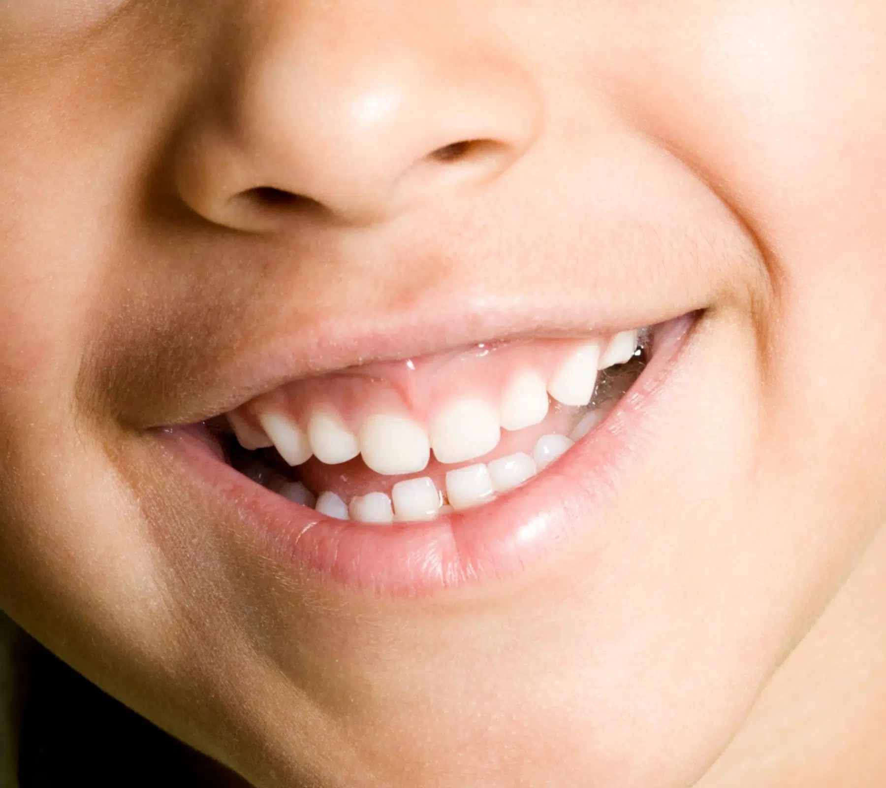 上唇垂直長度過短也會影響笑齦